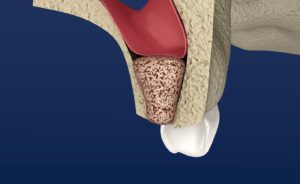 Model of bone grafting before dental implants